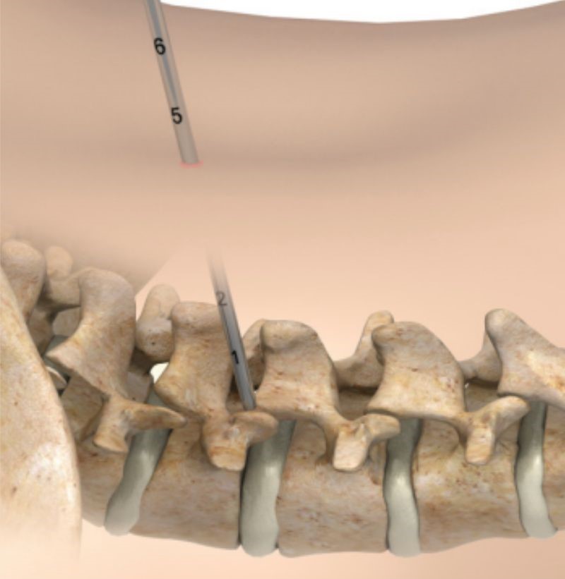 A thin wire or needle is inserted through tissues and muscles to the level of the spine