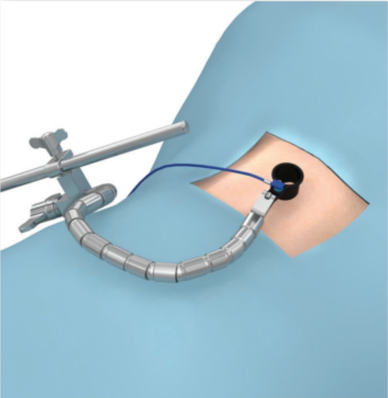 Retractor with lighting component