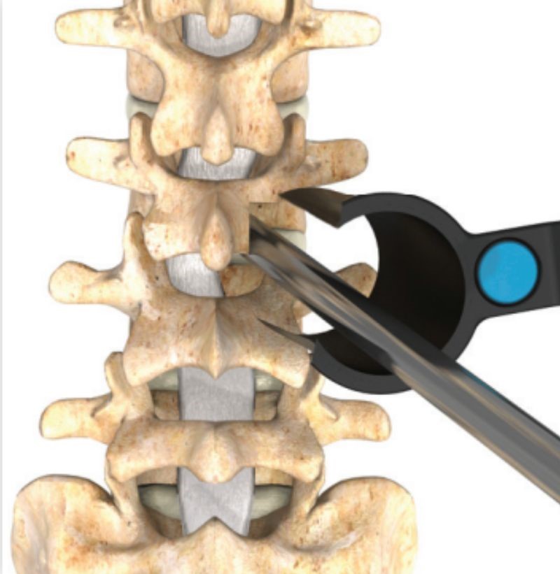 Removal of the laminae and facet joints