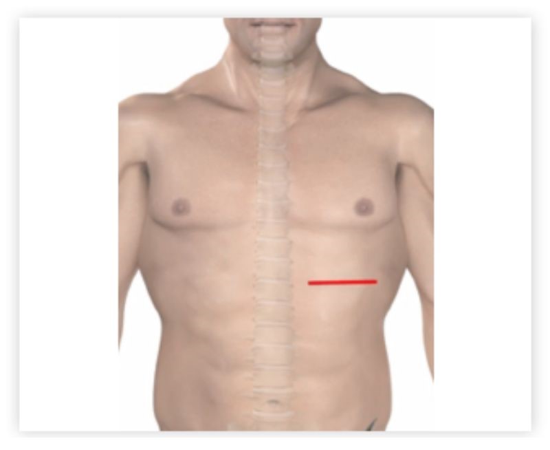 Thoracolumbar Vertebral Body Replacement - Step 1