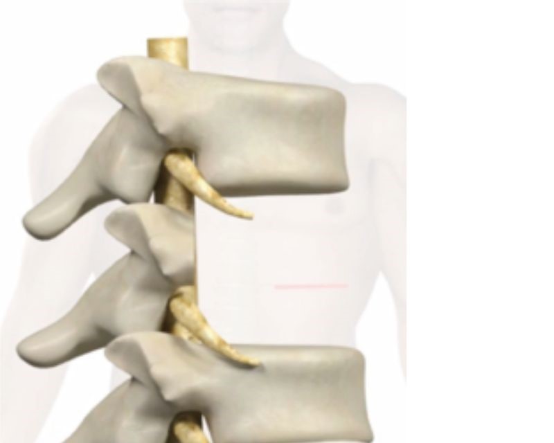 Thoracolumbar Vertebral Body Replacement - Step 2