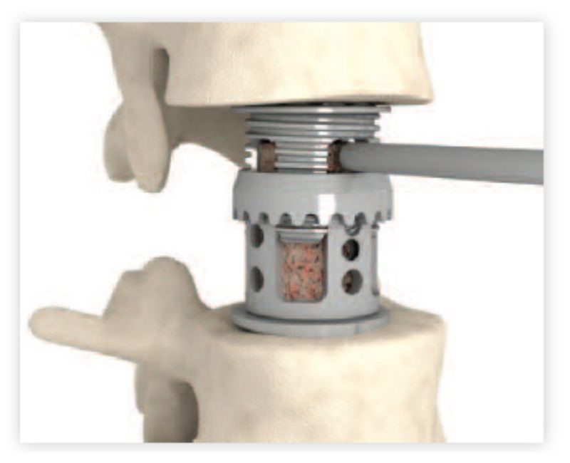 Thoracolumbar Vertebral Body Replacement - Step 3