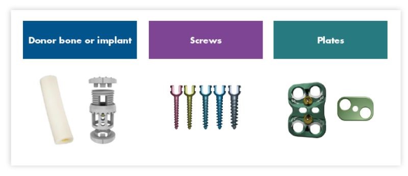 Thoracolumbar Vertebral Body Replacement - Step 4